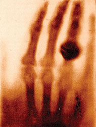 Wilhelm Rontgen took this radiograph of his wife's left hand on December 22, 1895, shortly after his discovery of X-rays.